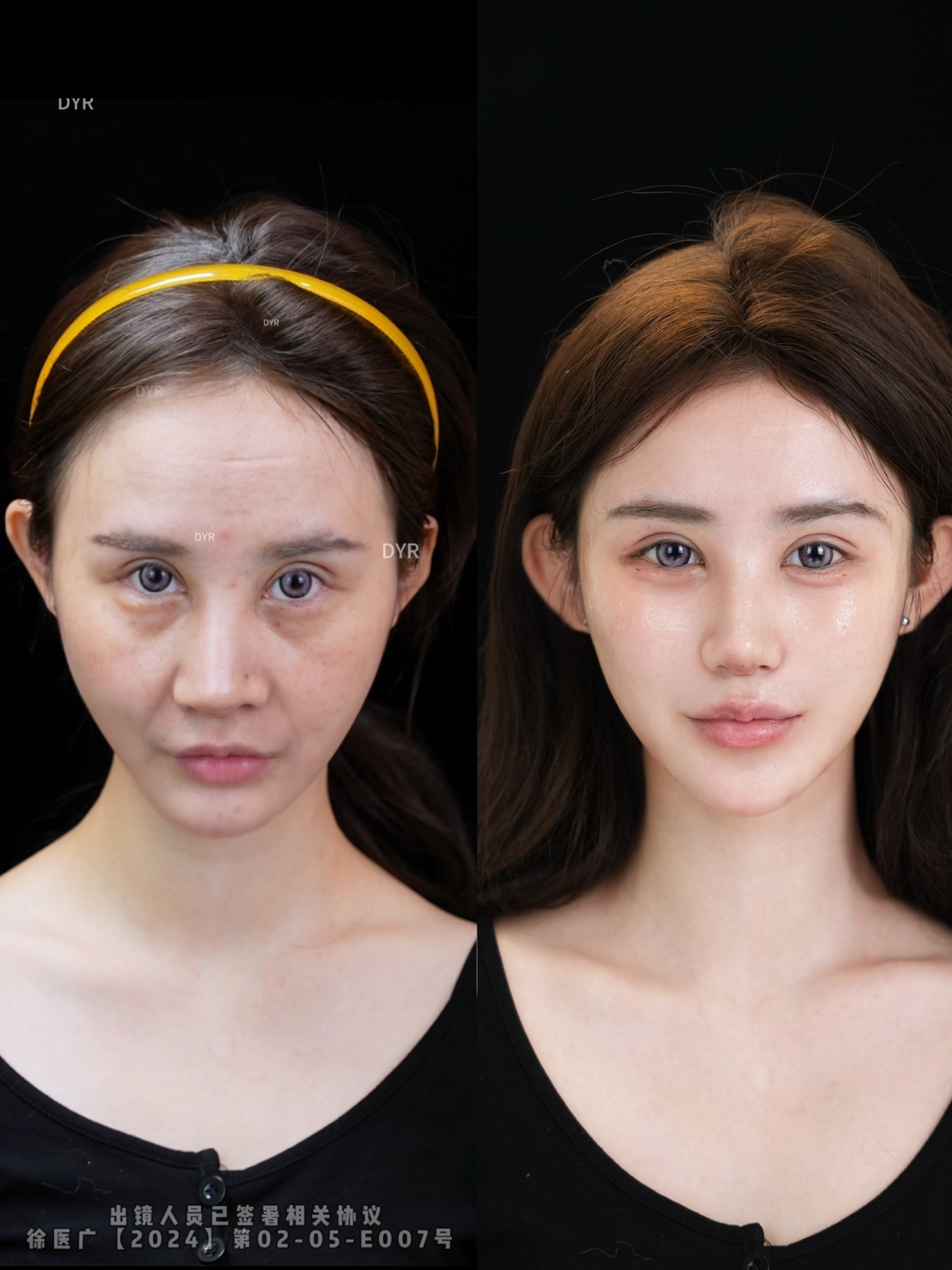 Consented Baby Face case 09
