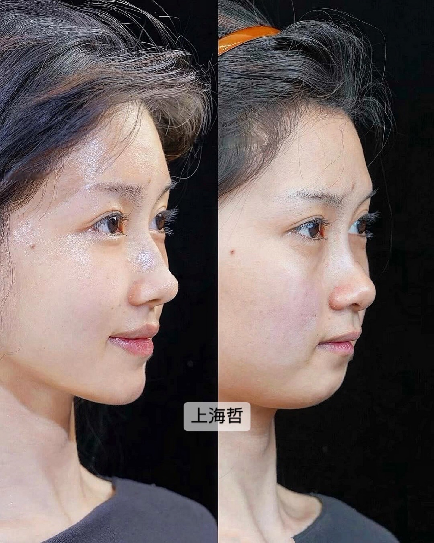 Consented Baby Face case 29