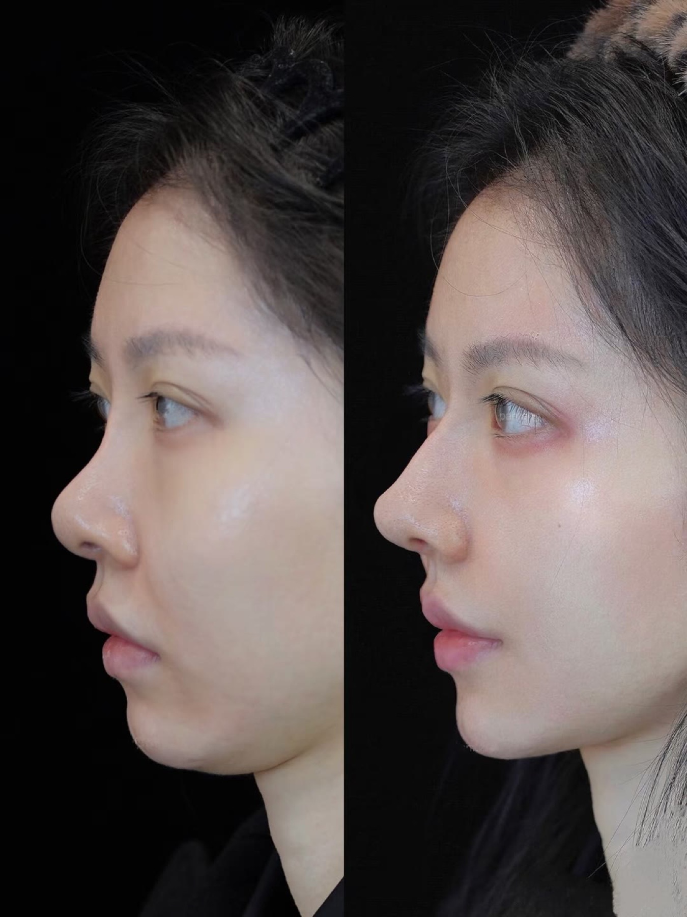 Consented Baby Face case 46