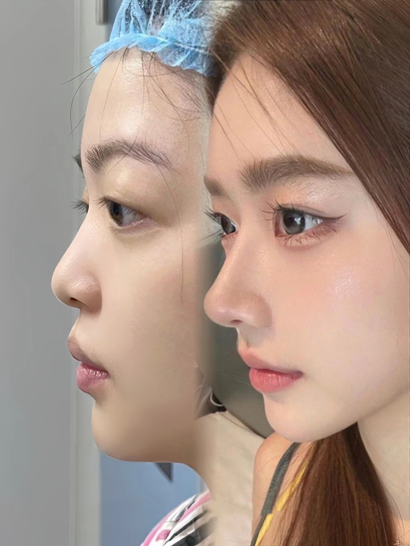 Consented Baby Face case 15