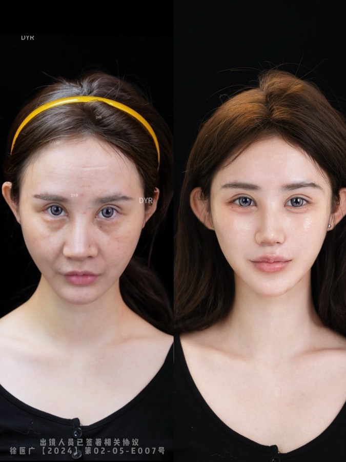 Historical facial lifting and Baby Face case 09
