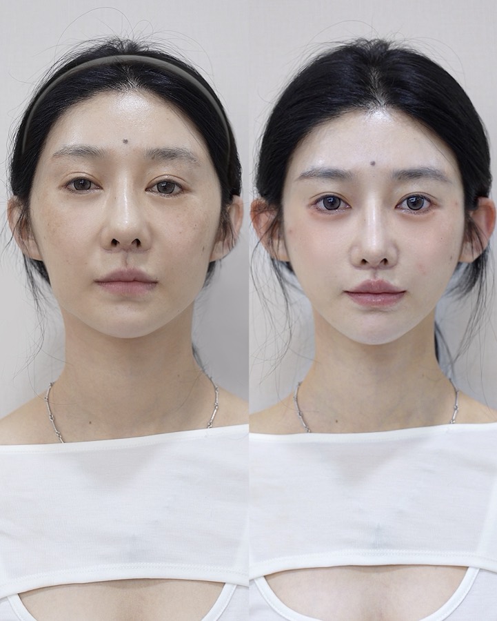 Historical facial lifting and Baby Face case 01